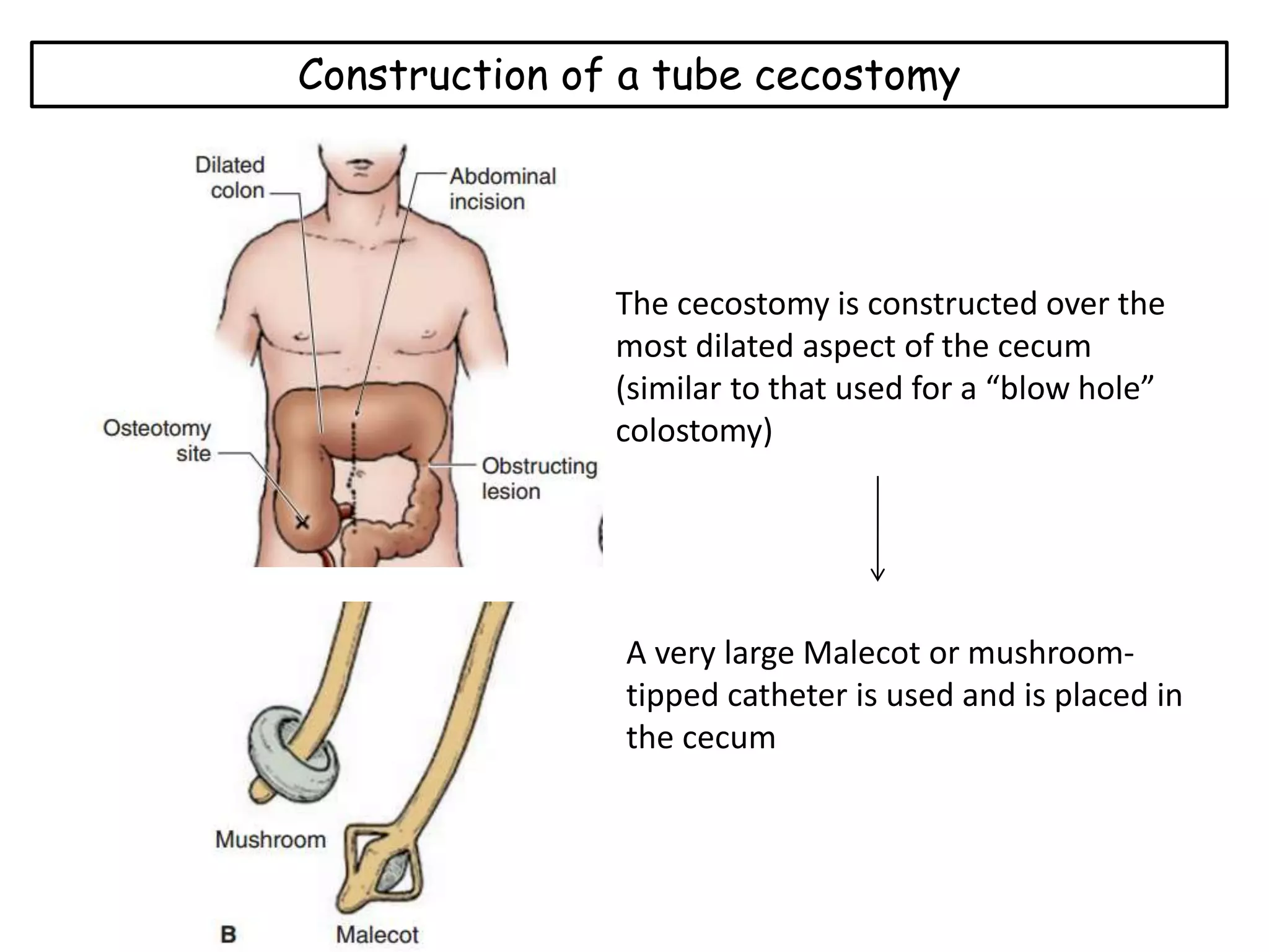 Colostomy -Large intestine | PPTX