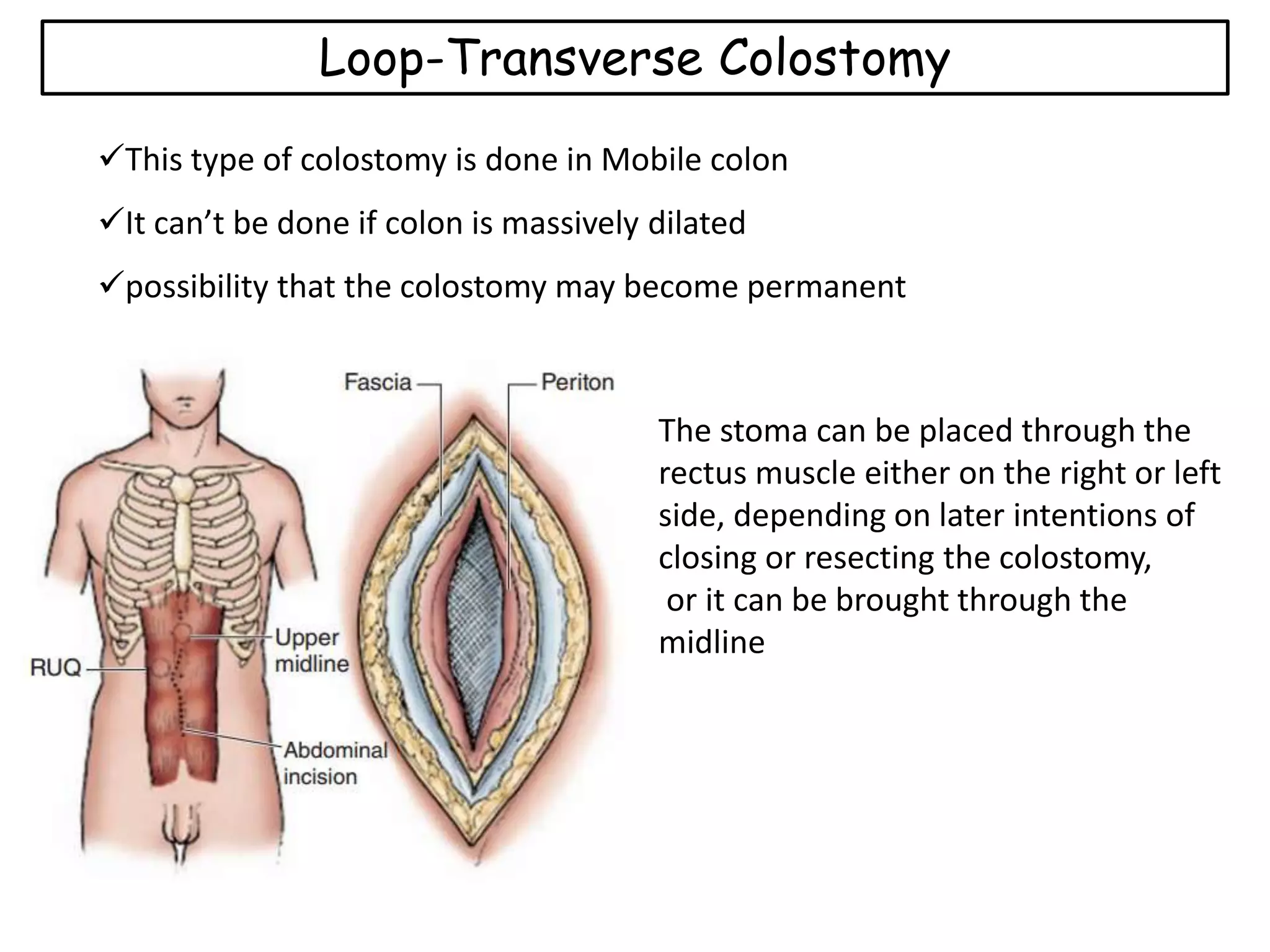 Colostomy -Large intestine | PPTX