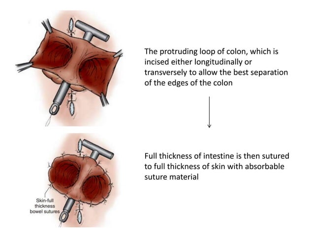 Colostomy -Large intestine | PPT