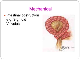 Mechanical
 Intestinal obstruction
e.g. Sigmoid
Volvulus
 