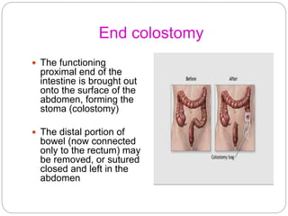 End colostomy
 The functioning
proximal end of the
intestine is brought out
onto the surface of the
abdomen, forming the
...
