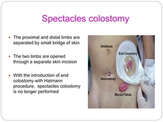 Spectacles colostomy
 The proximal and distal limbs are
separated by small bridge of skin
 The two limbs are opened
thro...