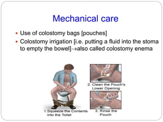 Mechanical care
 Use of colostomy bags [pouches]
 Colostomy irrigation [i.e. putting a fluid into the stoma
to empty the...