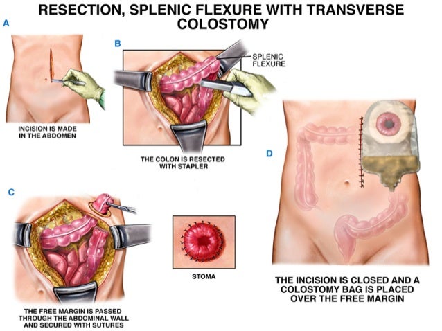 how do colostomy bags work how do colostomy bags work