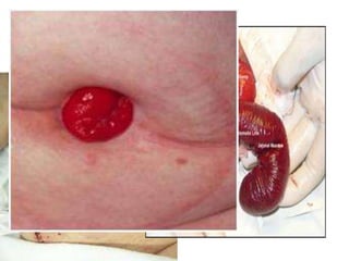 COMPLICATION
• Necrosis of Stoma
• Retraction of Stoma
• Prolapsed of stoma
• Stenosis or Narrowing
• Parastomal hernia
 