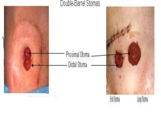 ACCORDING TO STOMA NUMBER &
TYPE
• Single – Barrel Colostomy
• Double – Barrel Colostomy
• Loop Colostomy
 