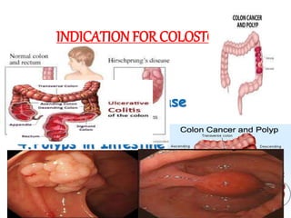 INDICATIONFOR COLOSTOMY
1.Colon Cancer
2.Hirschprung’s Disease
3.Ulcerative Colitis
4.Polyps in Intestine
 