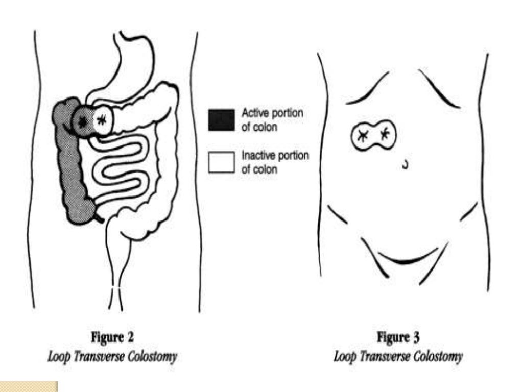 Colostomy care
