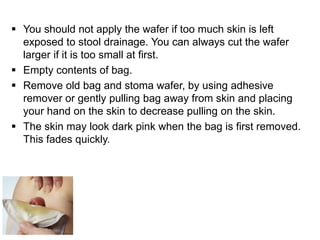  You should not apply the wafer if too much skin is left
exposed to stool drainage. You can always cut the wafer
larger if it is too small at first.
 Empty contents of bag.
 Remove old bag and stoma wafer, by using adhesive
remover or gently pulling bag away from skin and placing
your hand on the skin to decrease pulling on the skin.
 The skin may look dark pink when the bag is first removed.
This fades quickly.
 