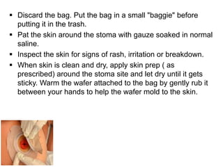  Discard the bag. Put the bag in a small "baggie" before
putting it in the trash.
 Pat the skin around the stoma with gauze soaked in normal
saline.
 Inspect the skin for signs of rash, irritation or breakdown.
 When skin is clean and dry, apply skin prep ( as
prescribed) around the stoma site and let dry until it gets
sticky. Warm the wafer attached to the bag by gently rub it
between your hands to help the wafer mold to the skin.
 