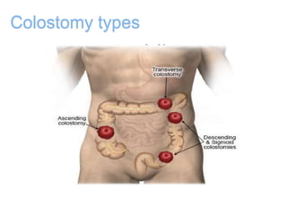 Colostomy types
 