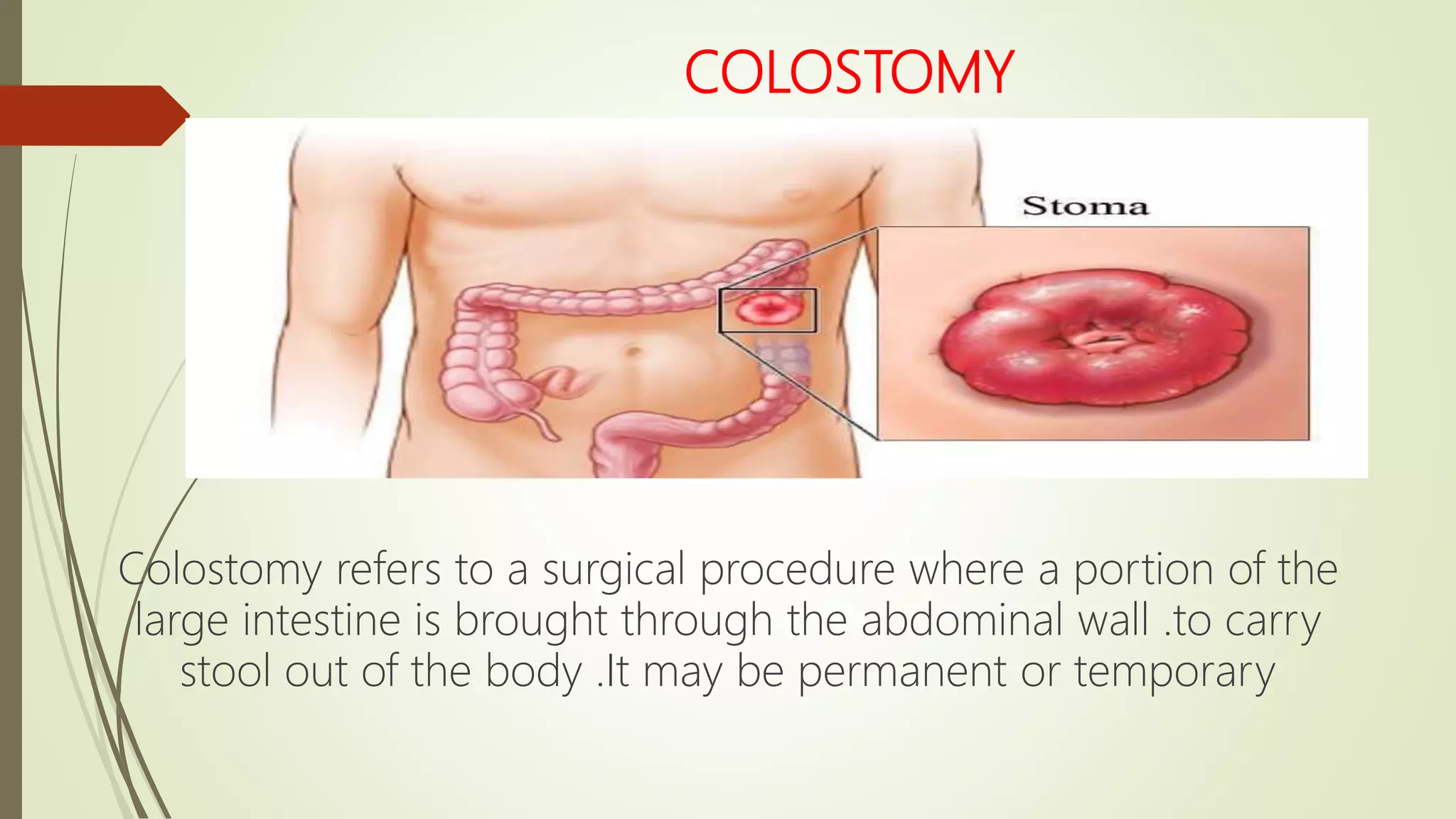 Colostomy care | PPTX