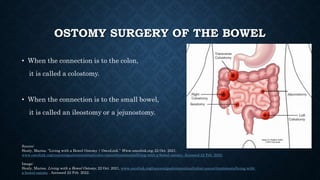 OSTOMY SURGERY OF THE BOWEL
• When the connection is to the colon,
it is called a colostomy.
• When the connection is to t...