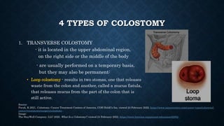 4 TYPES OF COLOSTOMY
1. TRANSVERSE COLOSTOMY
- it is located in the upper abdominal region,
on the right side or the middl...