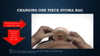 CHANGING ONE PIECE STOMA BAG
Source:
Bryce, E 2017, How your digestive system works - Emma Bryce, YouTube, viewed 24 Febru...