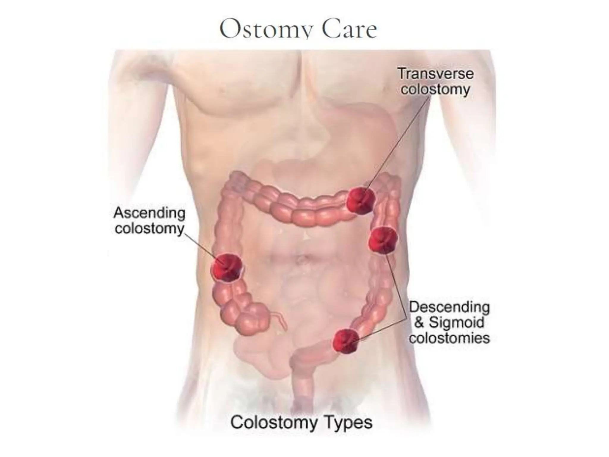 colostomy care APPLICATION PROCEDURE.pptx