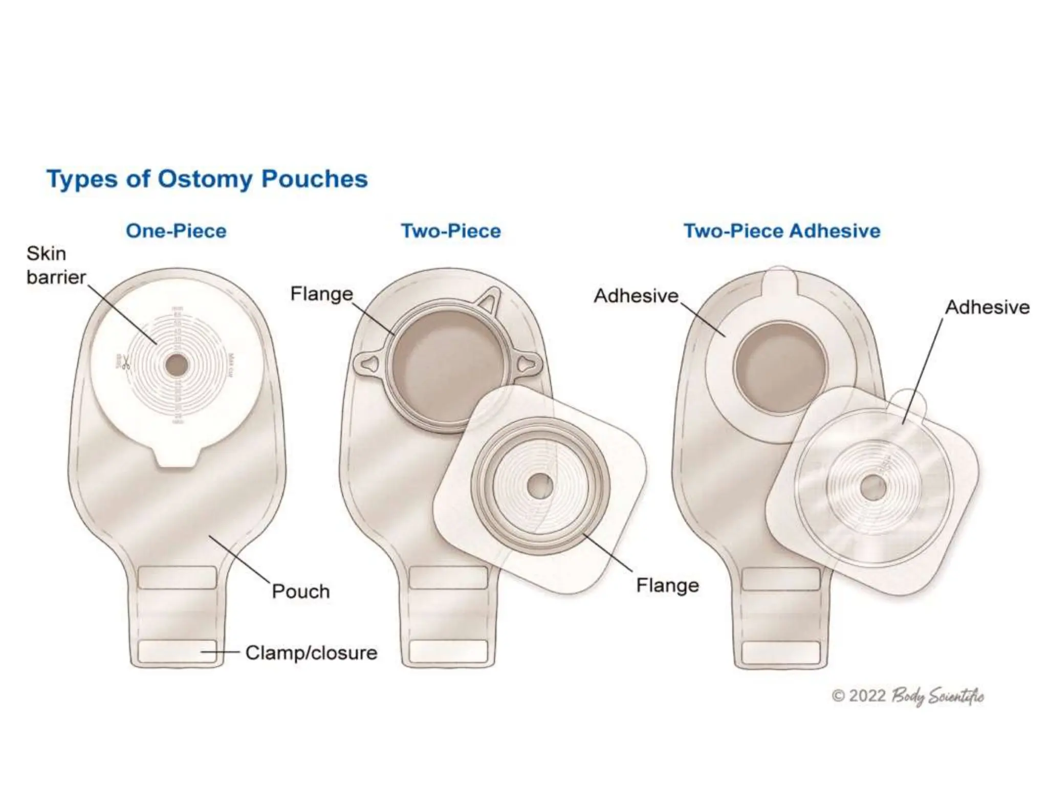 colostomy care APPLICATION PROCEDURE.pptx