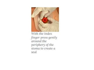 colostomy care APPLICATION PROCEDURE.pptx