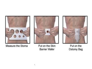 colostomy care APPLICATION PROCEDURE.pptx