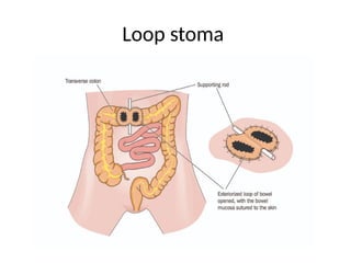 Loop stoma
 