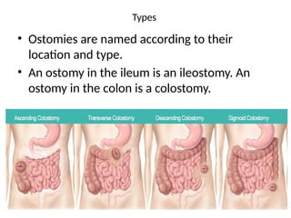 Types
• Ostomies are named according to their
location and type.
• An ostomy in the ileum is an ileostomy. An
ostomy in the colon is a colostomy.
 