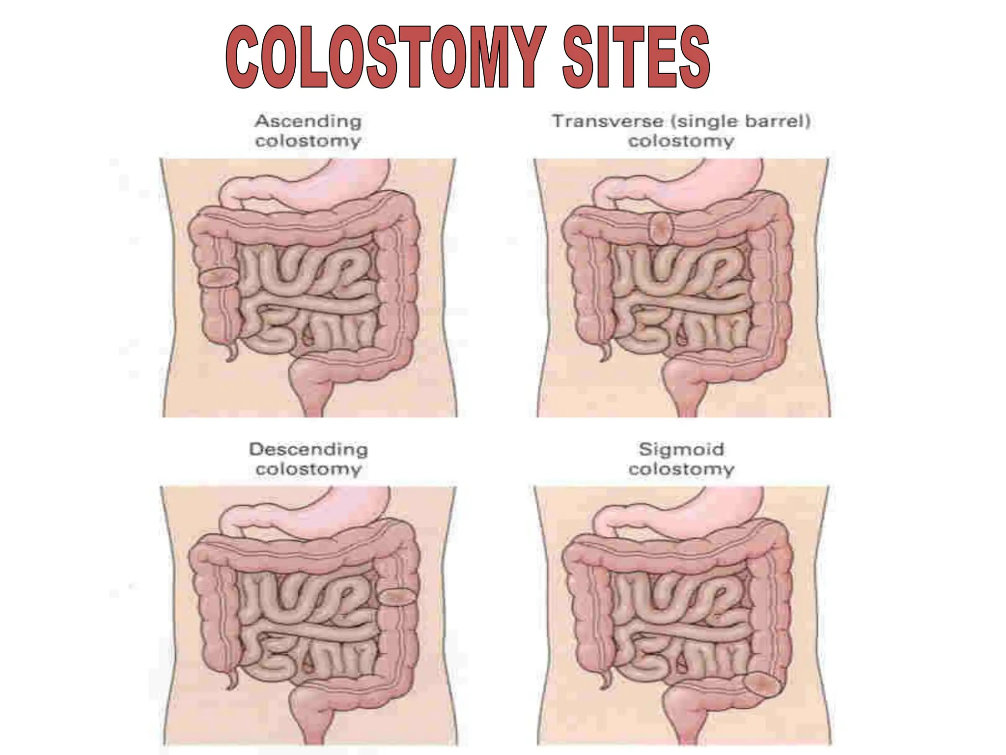 colostomy site and complication power point explanation | PPTX