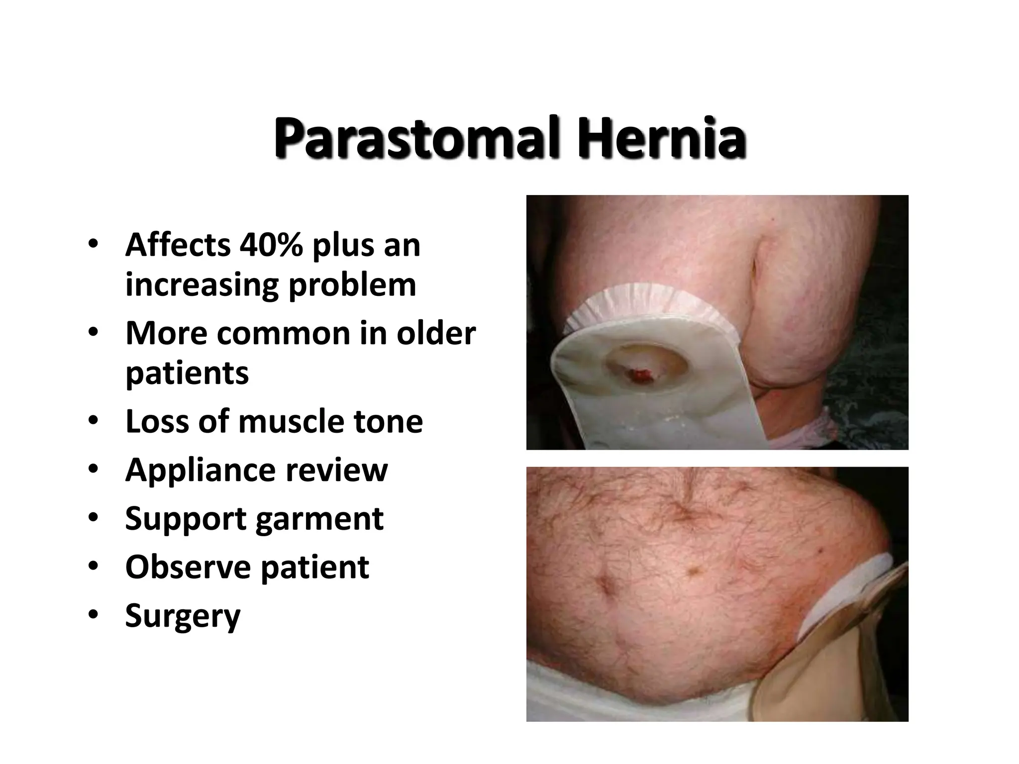 colostomy site and complication power point explanation | PPTX