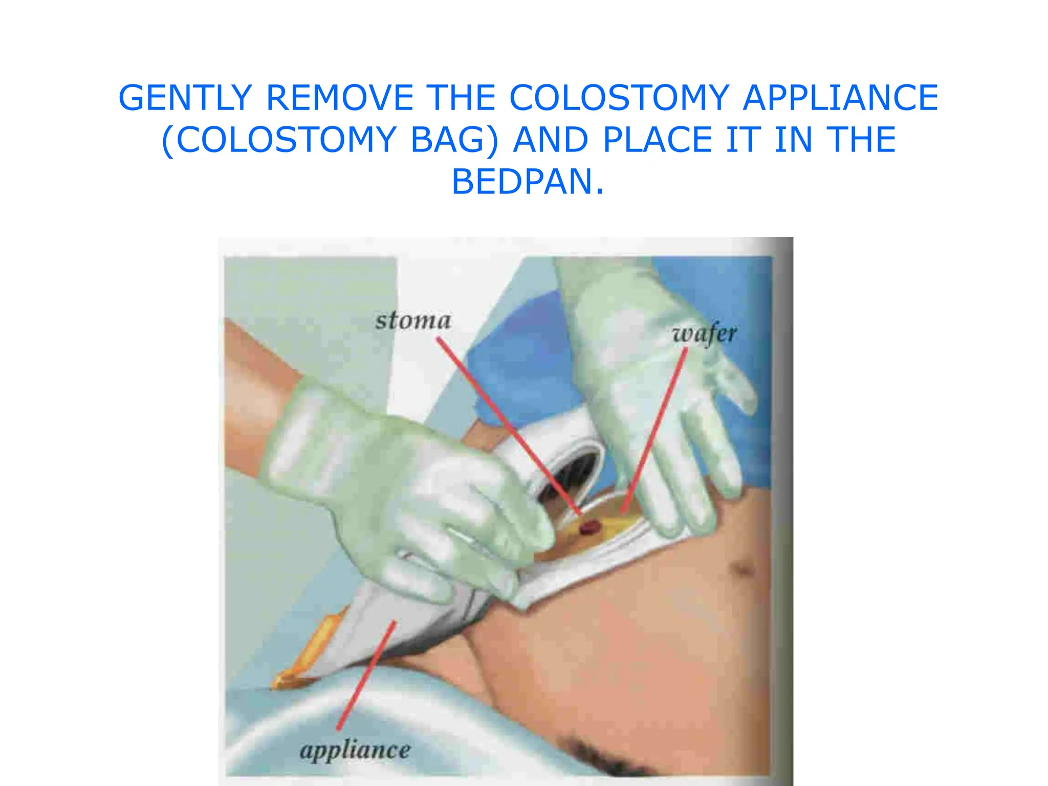 colostomy site and complication power point explanation | PPTX