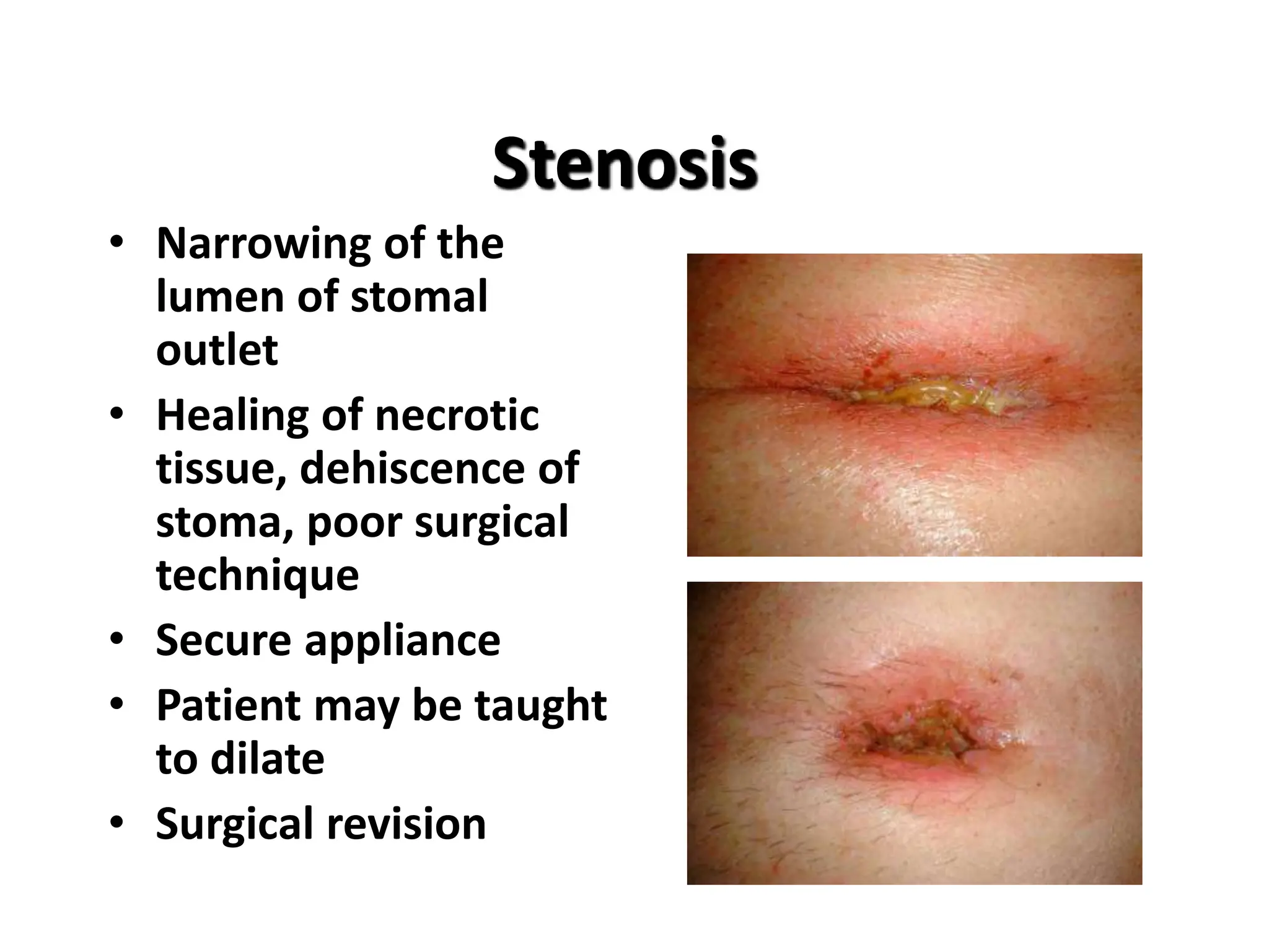 colostomy-site-and-complication-power-point-explanation-pptx