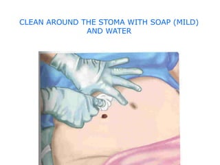 colostomy site and complication power point explanation | PPTX