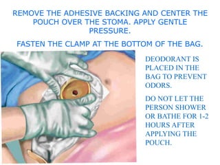 colostomy site and complication power point explanation | PPTX
