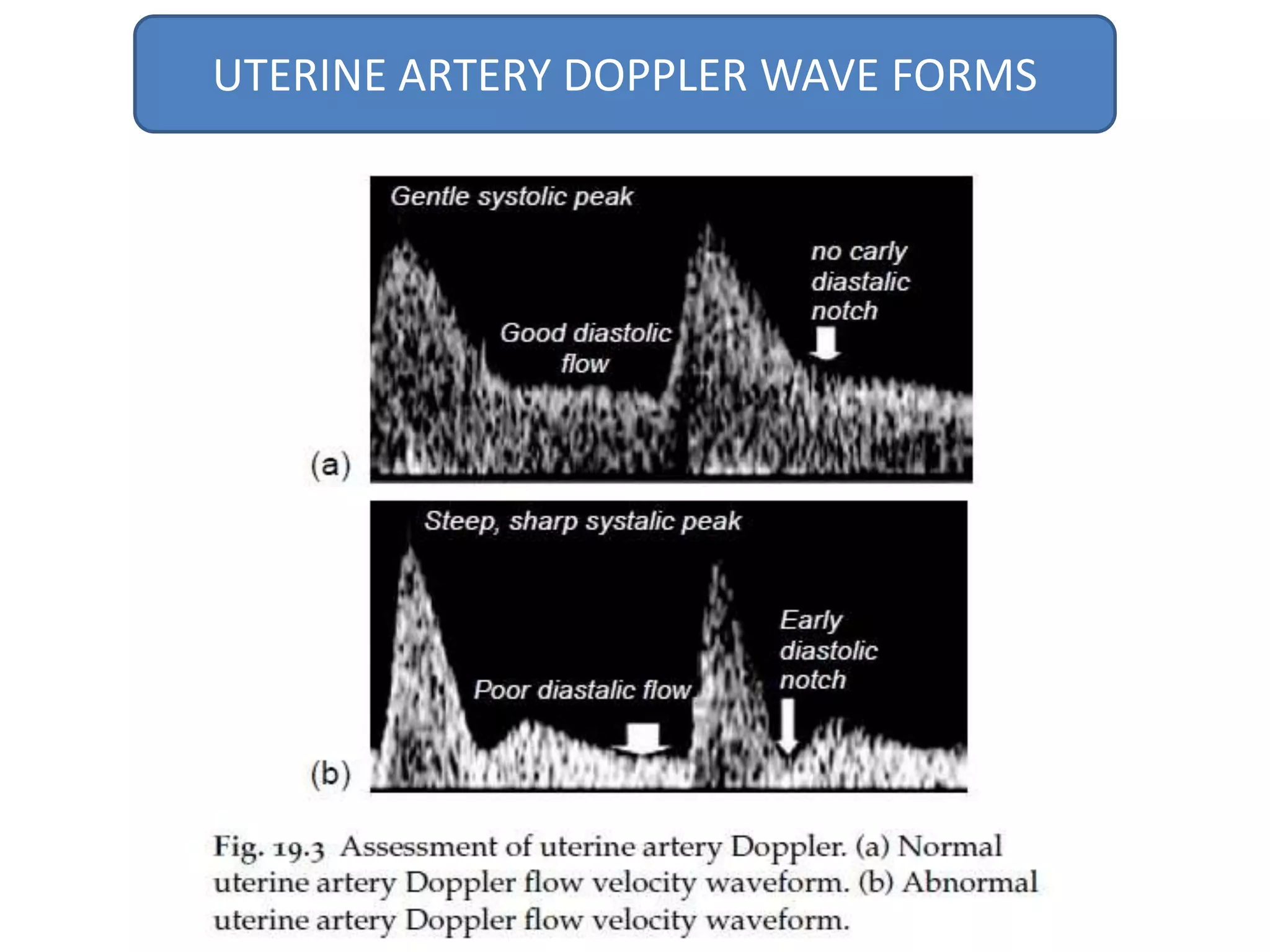 UTERINE ARTERY DOPPLER WAVE FORMS
 
