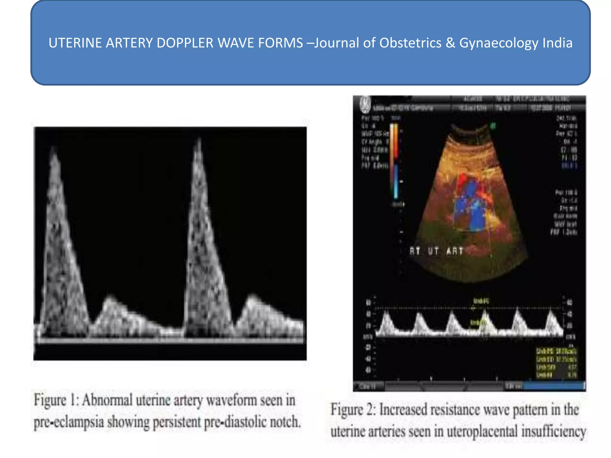 UTERINE ARTERY DOPPLER WAVE FORMS –Journal of Obstetrics & Gynaecology India
 