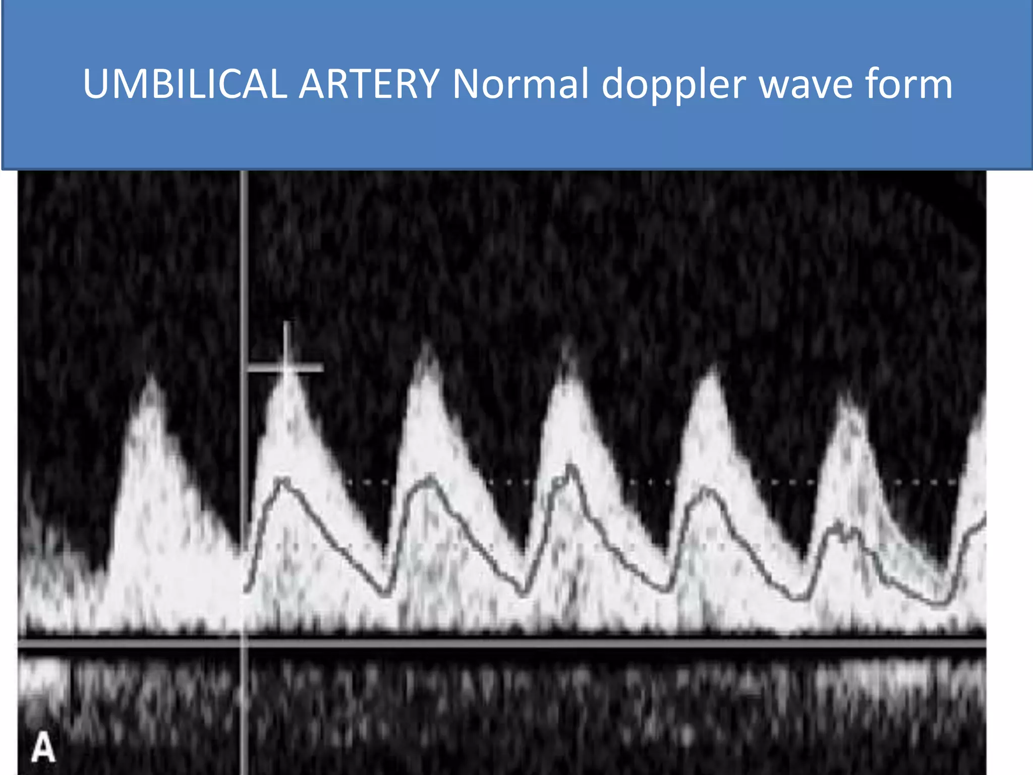 UMBILICAL ARTERY Normal doppler wave form
 