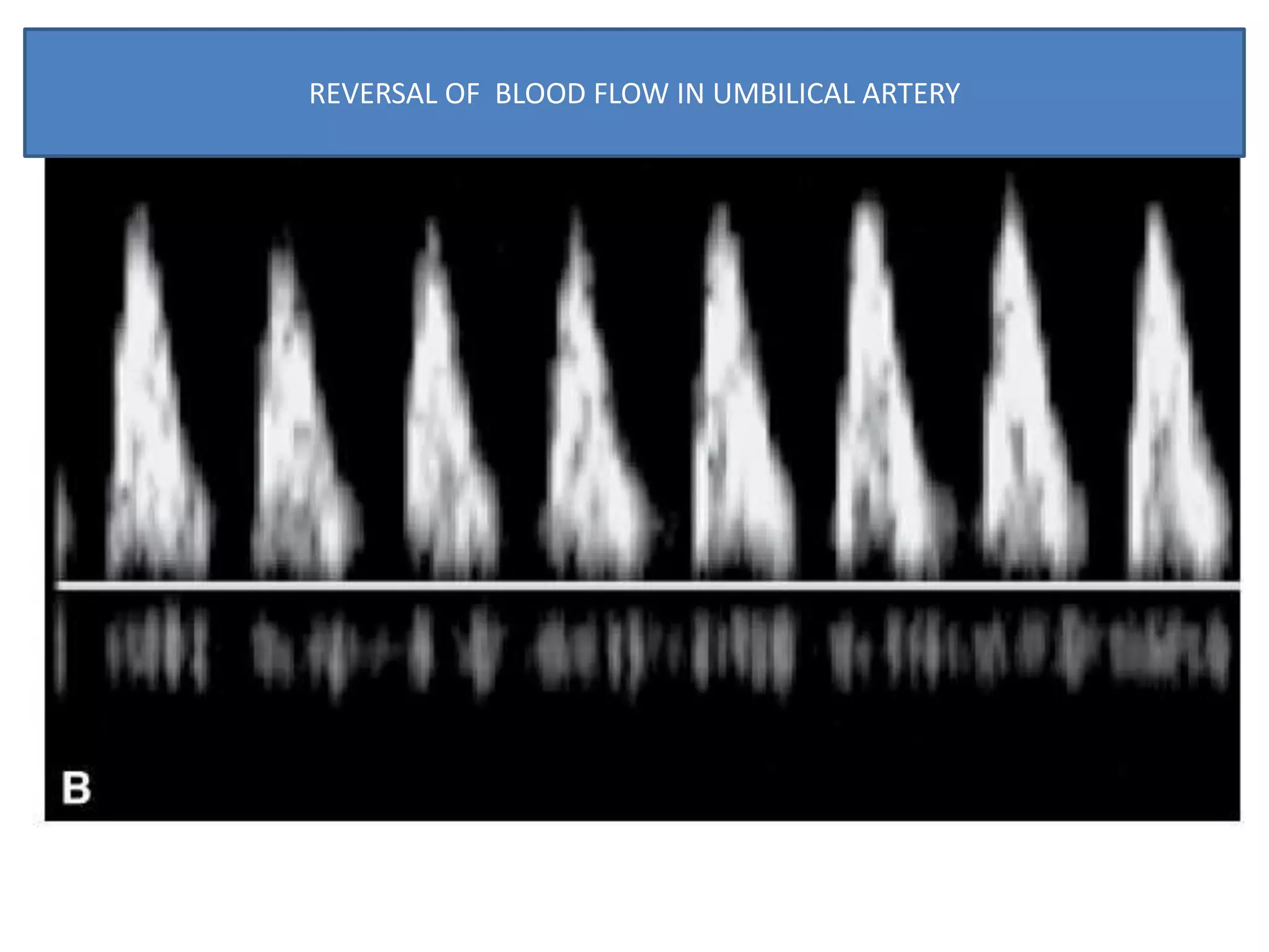 REVERSAL OF BLOOD FLOW IN UMBILICAL ARTERY
 
