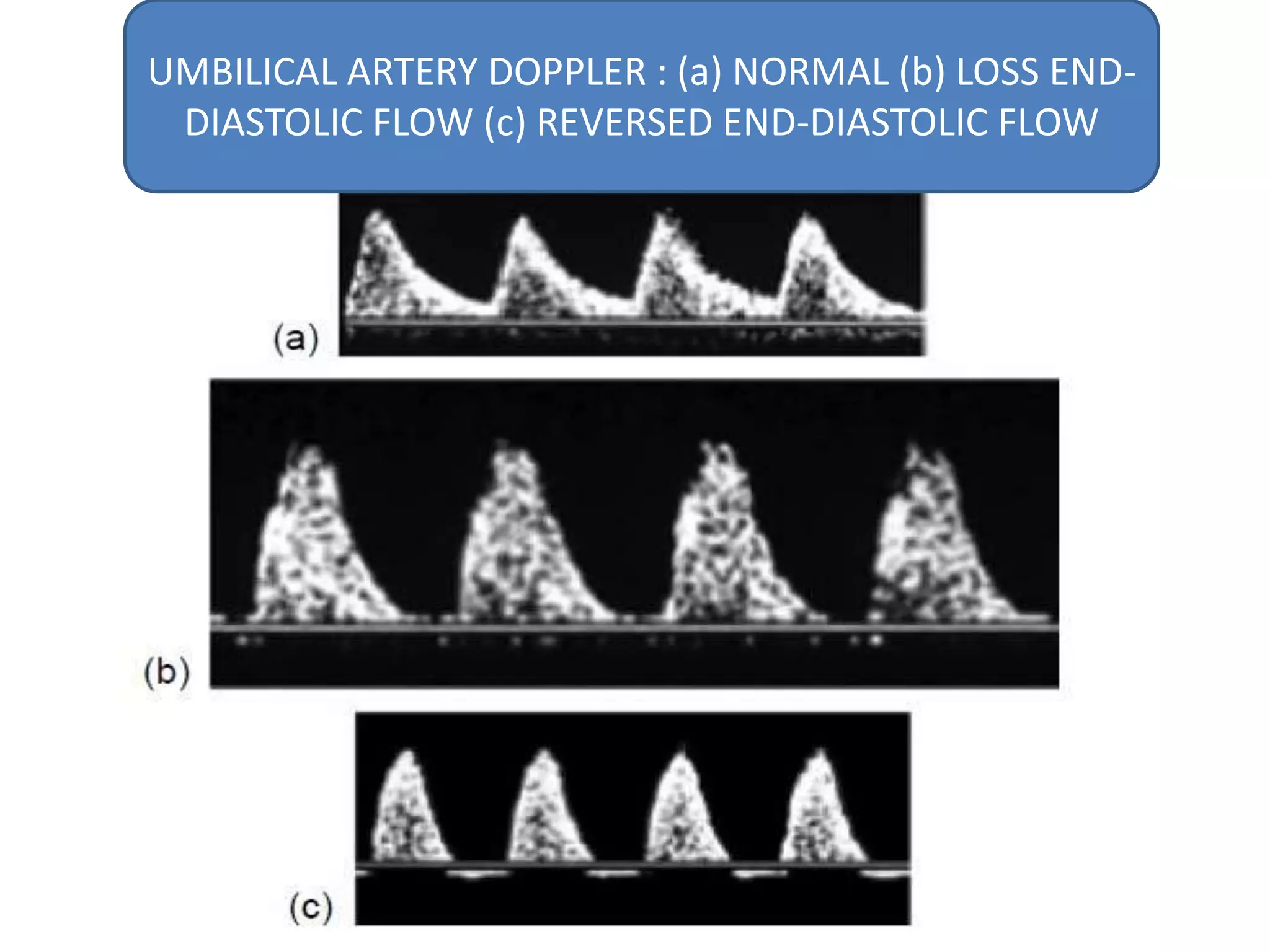 UMBILICAL ARTERY DOPPLER : (a) NORMAL (b) LOSS END-
 DIASTOLIC FLOW (c) REVERSED END-DIASTOLIC FLOW
 