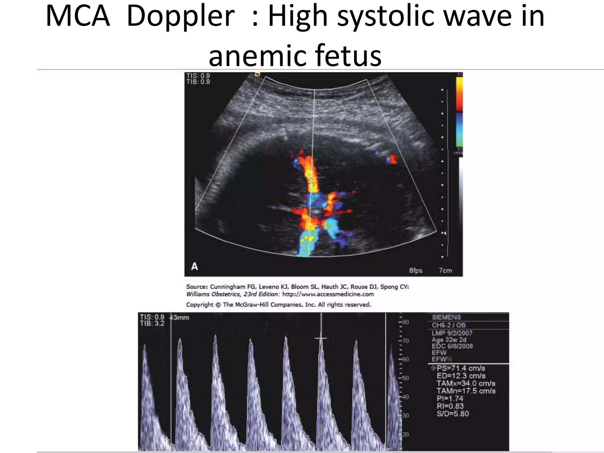 MCA Doppler : High systolic wave in
         anemic fetus
 