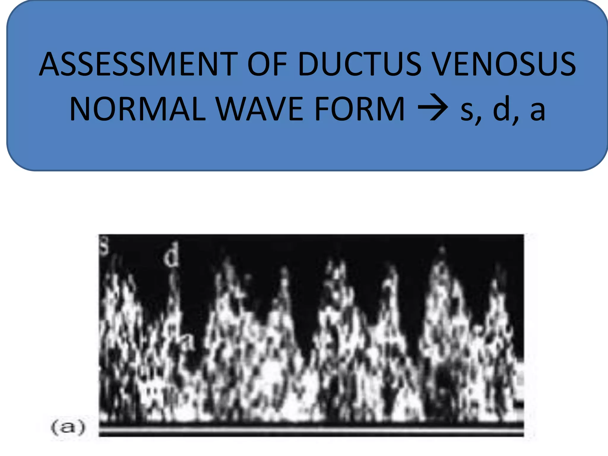 ASSESSMENT OF DUCTUS VENOSUS
 NORMAL WAVE FORM  s, d, a
 