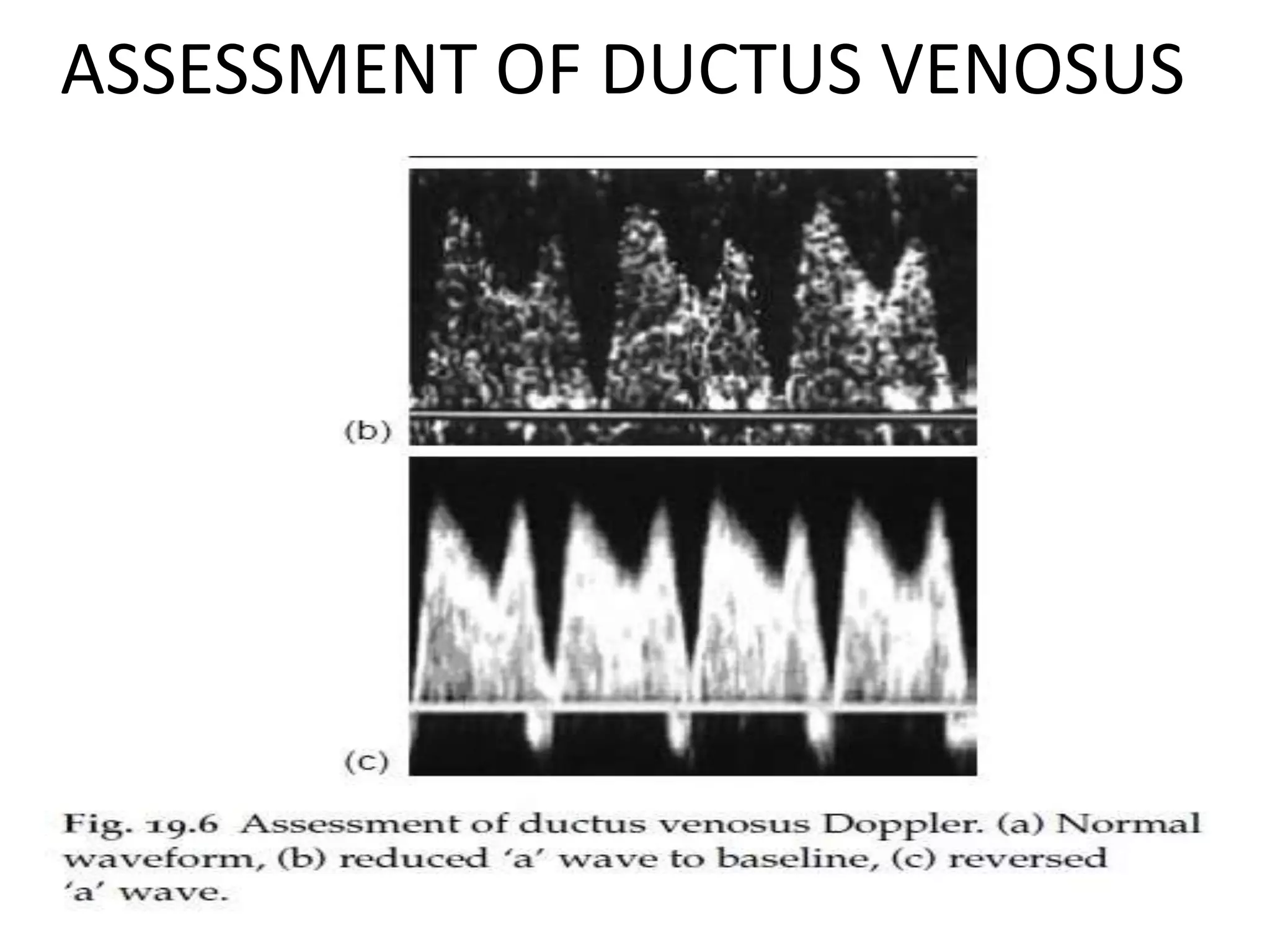ASSESSMENT OF DUCTUS VENOSUS
 