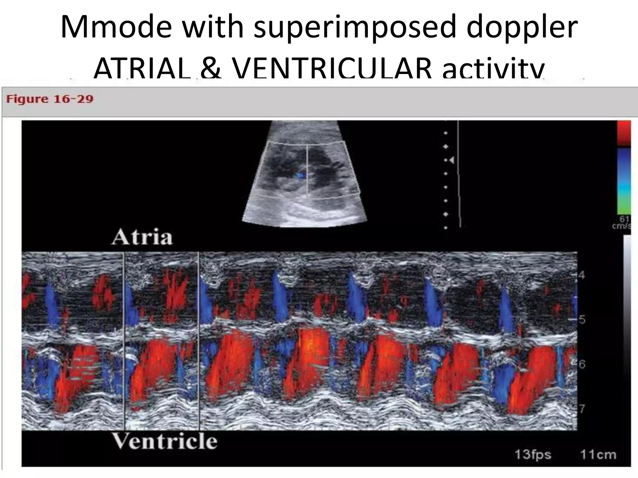 Mmode with superimposed doppler
 ATRIAL & VENTRICULAR activity
 