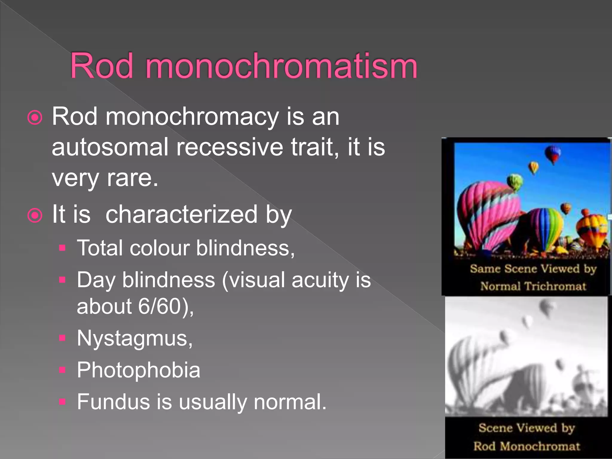  Rod monochromacy is an
autosomal recessive trait, it is
very rare.
 It is characterized by
 Total colour blindness,
 Day blindness (visual acuity is
about 6/60),
 Nystagmus,
 Photophobia
 Fundus is usually normal.
 