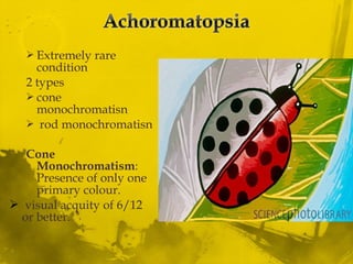  Extremely rare
condition
2 types
 cone
monochromatisn
 rod monochromatisn
Cone
Monochromatism:
Presence of only one
primary colour.
 visual acquity of 6/12
or better.
 