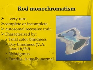  very rare
complete or incomplete
 autosomal recessive trait.
Characterized by:
• Total color blindness
• Day blindness (V.A.
about 6/60)
• Nystagmus
• Fundus is usally normal
 