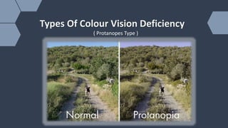 Colour Code Deficiency Colour Vison Deficency (CVD) | PPTX