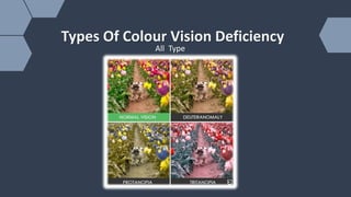 Vison Def Colour Vison Deficency (CVD) | PPTX