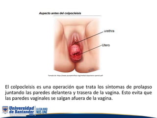 El colpocleisis es una operación que trata los síntomas de prolapso
juntando las paredes delantera y trasera de la vagina. Esto evita que
las paredes vaginales se salgan afuera de la vagina.
Tomado de: https://www.yourpelvicfloor.org/media/colpocleisis-spanish.pdf
 