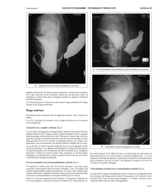 Radiodiagnostic COLPOCYSTOGRAMME : TECHNIQUE ET RÉSULTATS 34-625-A-10 
appelle position III (la retenue étant la position I, la poussée la position 
II) et qui consiste en un troisième cliché pris en poussée, mais en 
refoulant à l’aide d’une pince longuette montée en tampon, l’élément 
prolabé dominant. 
Les lésions peuvent s’observer au niveau de l’étage antérieur, de l’étage 
moyen et de l’étage postérieur. 
Étage antérieur 
Positionnements anormaux du bas appareil urinaire : base vésicale et 
urètre. 
Le CCG a permis de montrer trois images distinctes de la région 
cervicotrigonale. 
Cystocèle avec coudure urétrale (fig 2) 
La cystocèle, de diagnostic clinique facile, répond à une convexité de la 
portion inférieure de l’image vésicale faisant bomber la paroi vaginale 
antérieure dans la direction de la vulve. Elle peut n’exister que lors de la 
poussée, lorsque les muscles releveurs sont encore fonctionnels, ou être 
déjà présente lors de la retenue et atteindre parfois un volume très 
important, avec au maximum une extériorisation complète de la vessie. 
La cystocèle est dans la grande majorité des cas accompagnée d’une 
cervicocystoptôse, avec déplacement global de l’image vésicale dont le 
col descend parfois très en dessous du bord inférieur de la symphyse 
pubienne, l’urètre est alors coudé. Plus rarement, et surtout après 
chirurgie, la cystocèle peut se faire en arrière du col vésical, qui reste à 
l’aplomb de la symphyse pubienne. 
Cervicocystoptôse avec horizontalisation urétrale (fig 3) 
Il s’agit de la chute isolée du col vésical, pouvant s’associer à une 
cystocèle intravaginale plus ou moins marquée. Liée à un déficit du 
système ligamentaire suspensif postérieur, la vessie reste mobile entre 
retenue et poussée, traduisant la conservation du pouvoir contractile des 
releveurs et correspondant à une hypermobilité du col vésical. 
Dans le cas d’une patiente jamais opérée, le diagnostic clinique de 
cervicocystoptôse se fait par la mise en évidence de l’incontinence en 
jet concomitante d’un effort de toux, et surtout par sa correction en 
repositionnant le col vésical dans l’enceinte abdominale : c’est la 
manoeuvre clinique de Bonney, facile pour une patiente examinable sans 
gros prolapsus associé et dont l’incontinence urinaire est mise en 
évidence en position allongée. 
Vésicalisation urétrale avec verticalisation urétrale (fig 4) 
Il s’agit là d’un aspect infundibulaire du col vésical, avec disparition lors 
de la retenue, de l’angle urétrovésical. En poussée, le col vésical s’ouvre 
comme lors d’une miction physiologique et l’image vésicale est au 
contraire figée entre les deux radiographies. 
2 Cystocèle et coudure urétrale (radiographie en poussée). 
3 Cervicocystoptôse et horizontalisation urétrale (radiographie en poussée). 
4 Vésicalisation urétrale (radiographie en poussée). 
page 3 
 