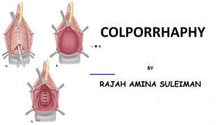 COLPORRHAPHY
BY
RAJAH AMINA SULEIMAN
 