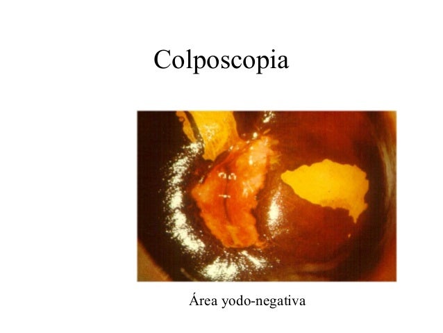Exame de colposcopia com biopsia