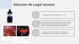 Solucion de Lugol acuosa
Solución de yodo se diluye 1:2 o 1:4.
Esta solución tiñe el epitelio cilíndrico normal maduro
no queratinizado de un color caoba oscuro, lo que
indica que las celulas presentan glucógeno.
La ausencia de tincion indica un estado no
glucogenado o una superficie queratinizada
 